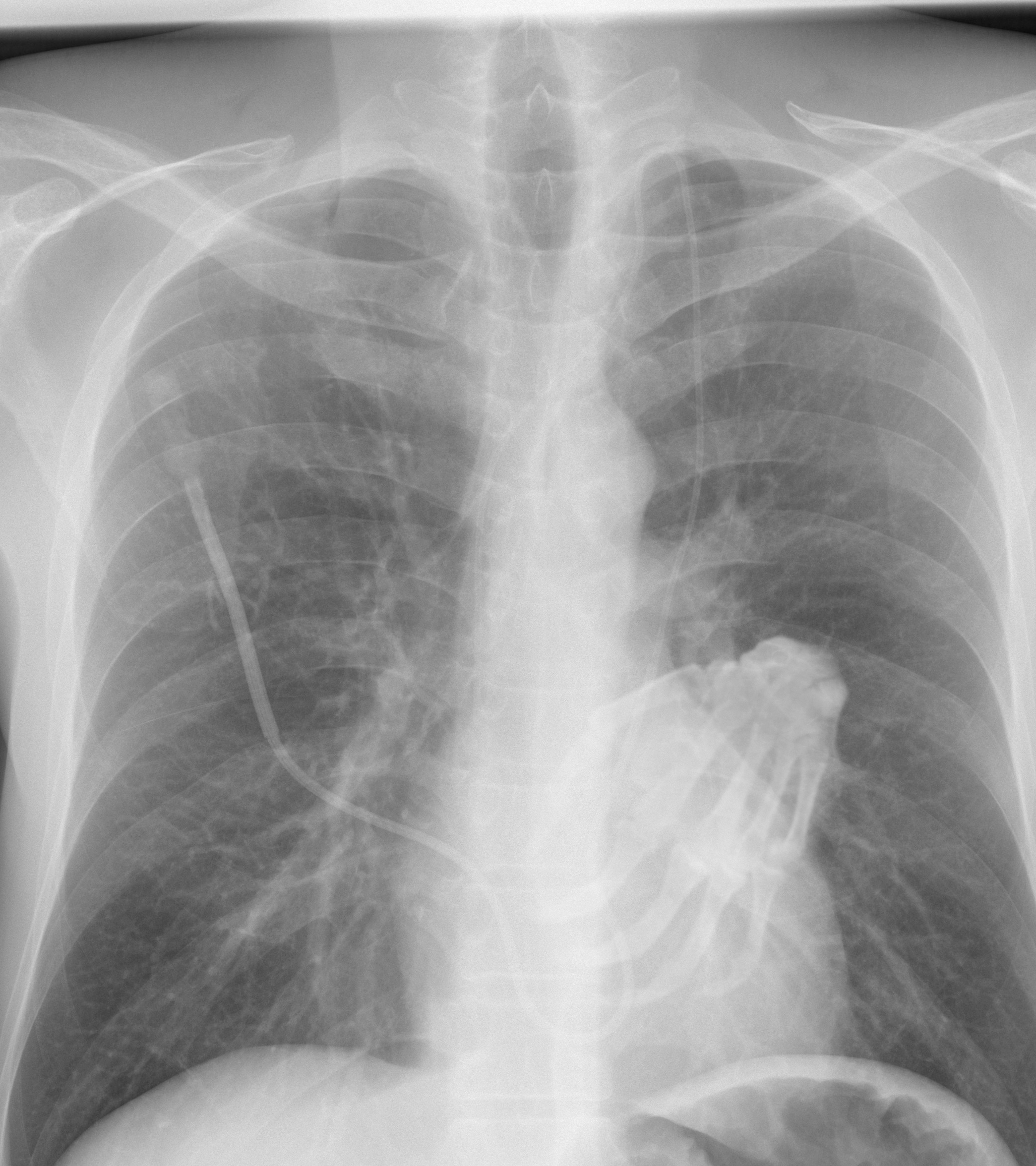 a_heart_xray_with_fingers_piercing_into_it.png
