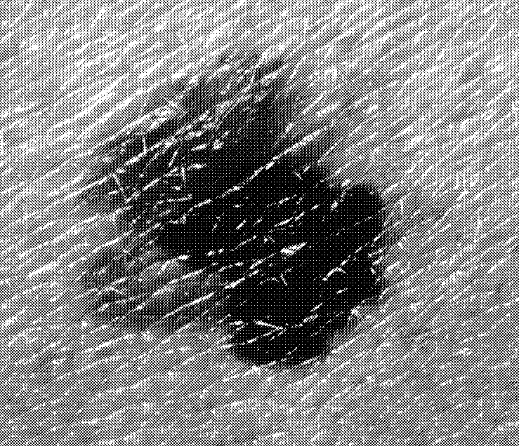 1280px-Melanoma_(4).jpg
