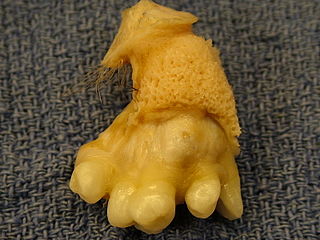 Ovarian_teratoma.jpg