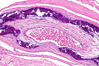 Arteriosclerosis.jpg