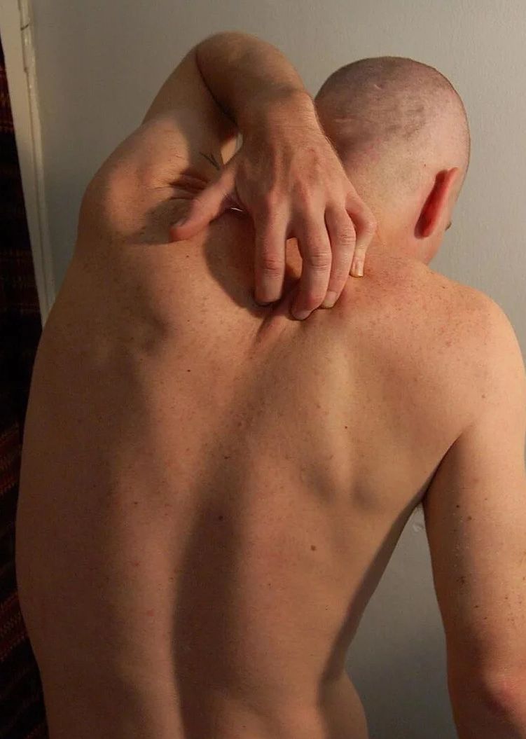 pruritus1