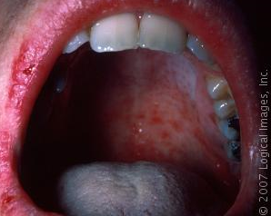 measles mouth.png