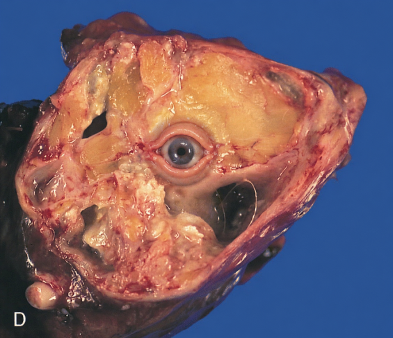 teratoma