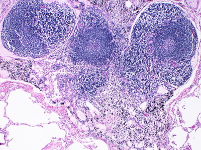 Intrapulmonary lymph node.jpeg